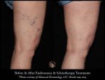 Fall in Love with Your Legs Again