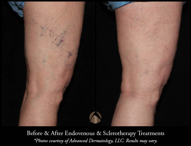 Fall in Love with Your Legs Again!