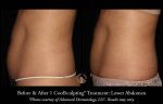 Most Common Questions: CoolSculpting®