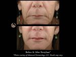 Most Common Questions: Fillers