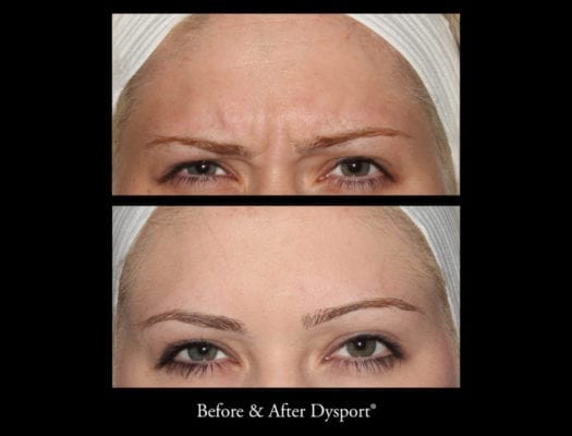 44654_beforeafterdysport_21691370720_o