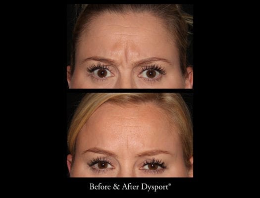 46277_beforeafterdysport2_21258353143_o