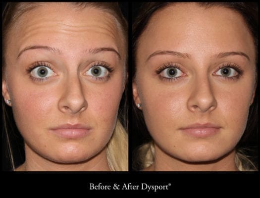 47018_beforeafterdysport_21258352533_o