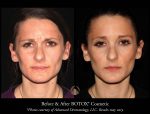 BOTOX® for the Upper Face