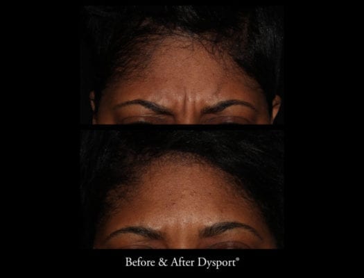 6397_beforeafterdysport_21879433365_o
