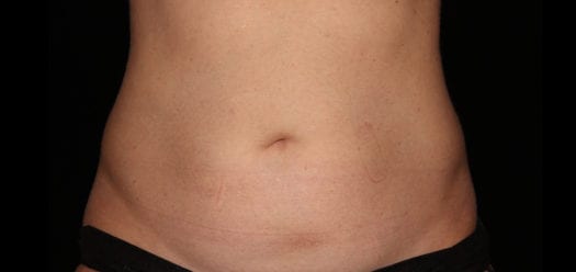 64098_coolsculpting_abdomenonly_after