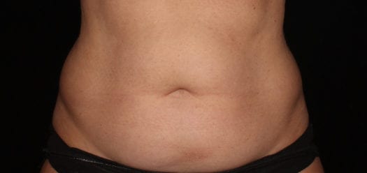 64098_coolsculpting_abdomenonly_before