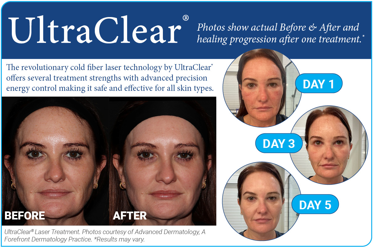 6468ad_ultraclearnewlasertreatment_900x600