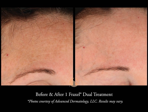 Resurfacing Lasers