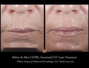 Before & After 1 Co2re Treatment