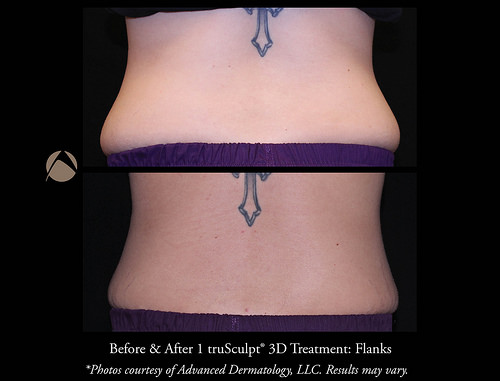 Body Shaping- CoolSculpting® and truSculpt® 3D