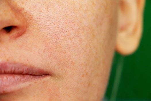 acne-enlarged-pores