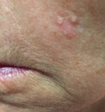 Actinic Keratoses Facts