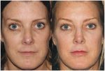 Two New Fillers For Lips: Restylane Silk & Volbella, Fall/Winter Newsletter 2016
