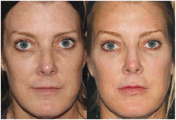 BA-Botox_Voluma_RestylaneSilk
