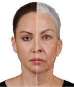 Fillers for Lift in the Face