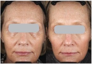 Before & after 3 Intensif Treatments. Results may vary. Photo courtesy of Amy Forman Taub, MD.