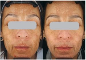 Before & after 3 out of 6 Permea treatments completed. Results may vary. Photo courtesy of Amy Forman Taub, MD.