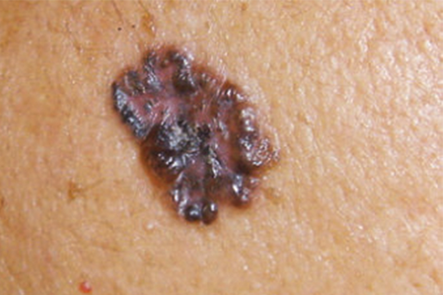 bcc-from-skin-cancer-foundation