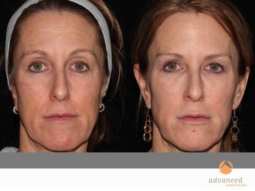 before-after-liquid-facelift_10329502543_o