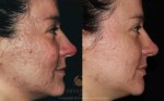 Bellafill® for Acne Scarring