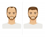How Men Deal With Hair Loss