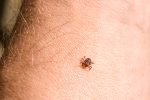 Tick Bites & Summer Protection