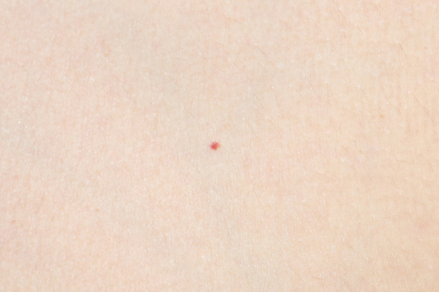 cherry-angioma