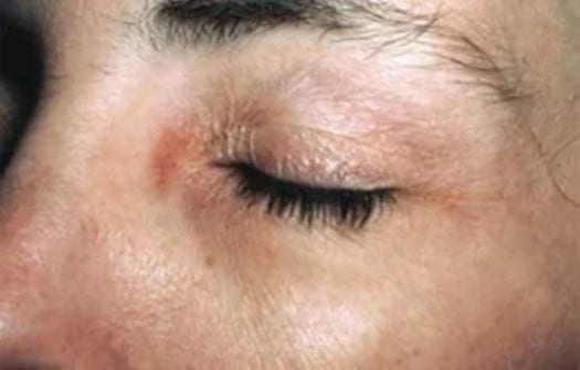 contact_dermatitis_landing