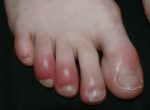 COVID Toes