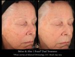 Erase Summer Sun Damage