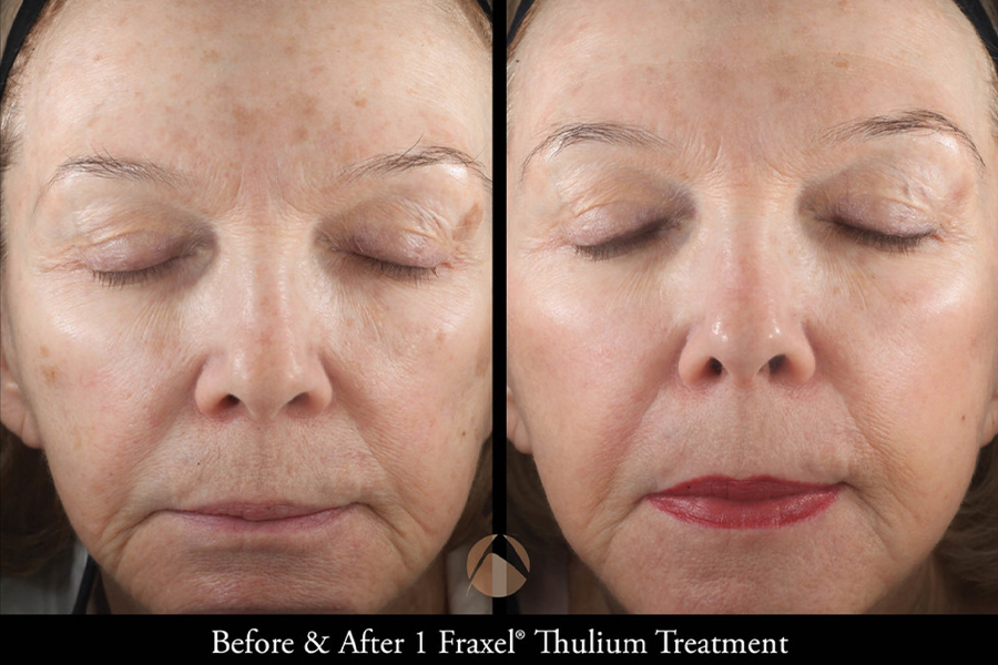 laser-skin-resurfacing-2