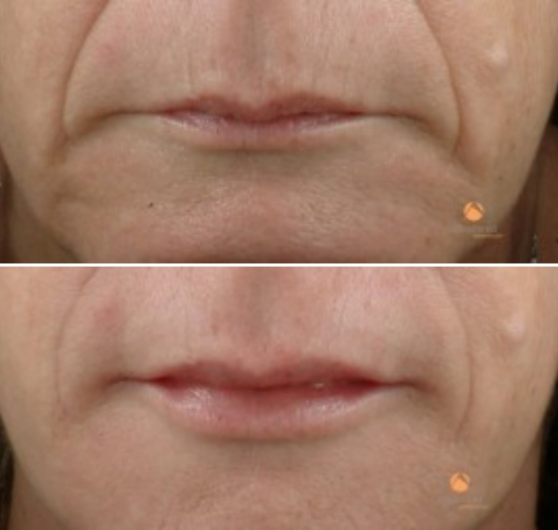 lips-before-and-after