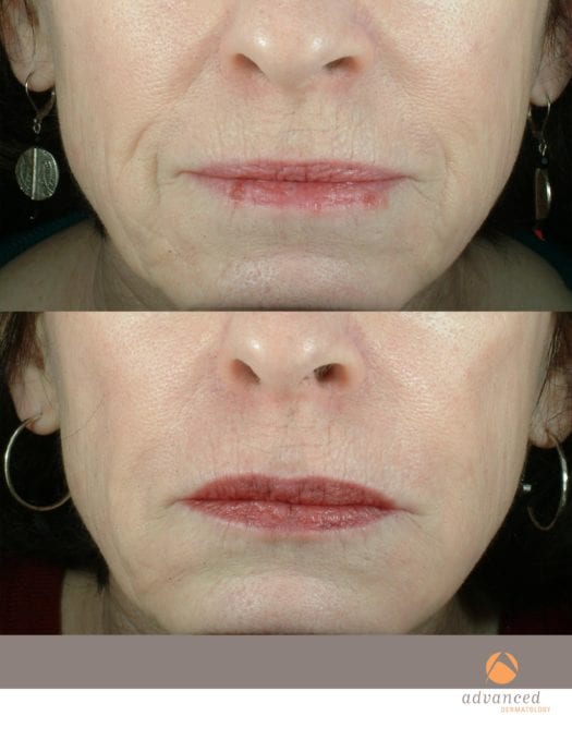 liquid-facelift-lower-face_8406850308_o
