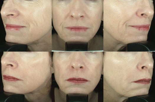 liquid-facelift-patient-from-dr-taubs-study_7367148792_o