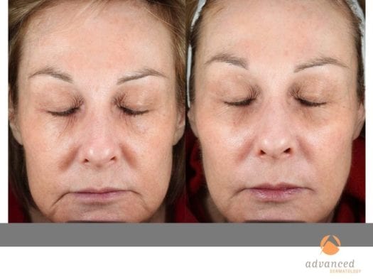 liquid-facelift_8405749959_o
