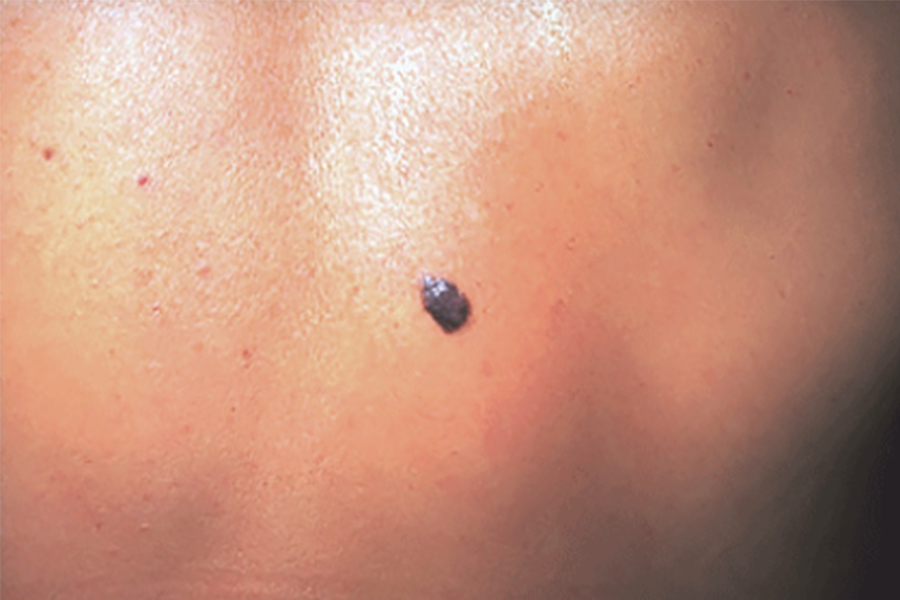 melanoma-from-aad