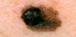 Time for a Body Check for Skin Cancers