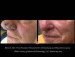 Rhinophyma