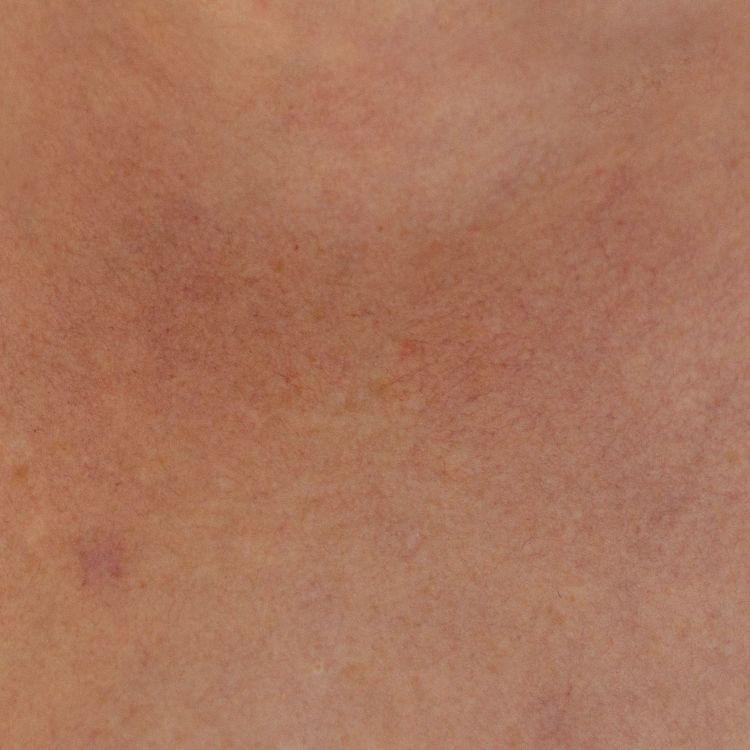 Your Guide to Managing Rosacea in the Sunny Season
