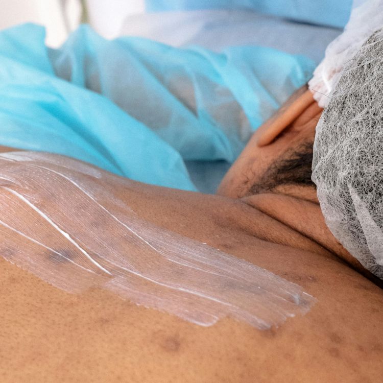 Understanding and Treating Truncal Acne