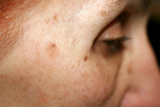 pigmentation-sun-freckles