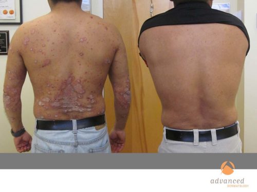 Advances in Psoriasis