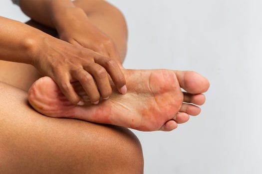 rashes-foot-fungus