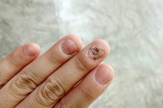 rashes-nail-fungus