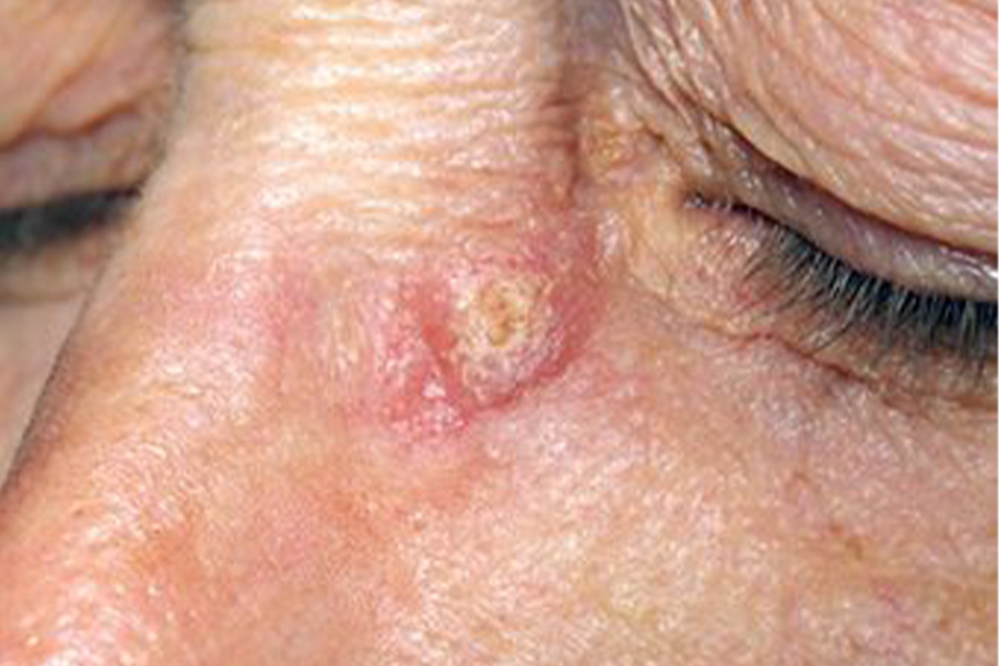 scc-from-skin-cancer-foundation