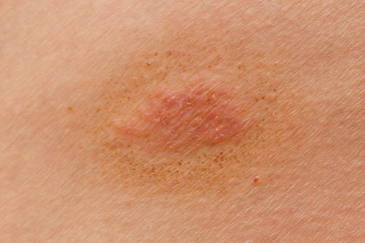 skin-rash-ringworm