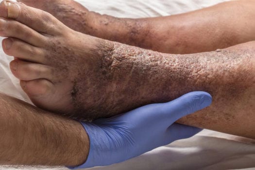 skin-rash-venous-stasis-dermatitis