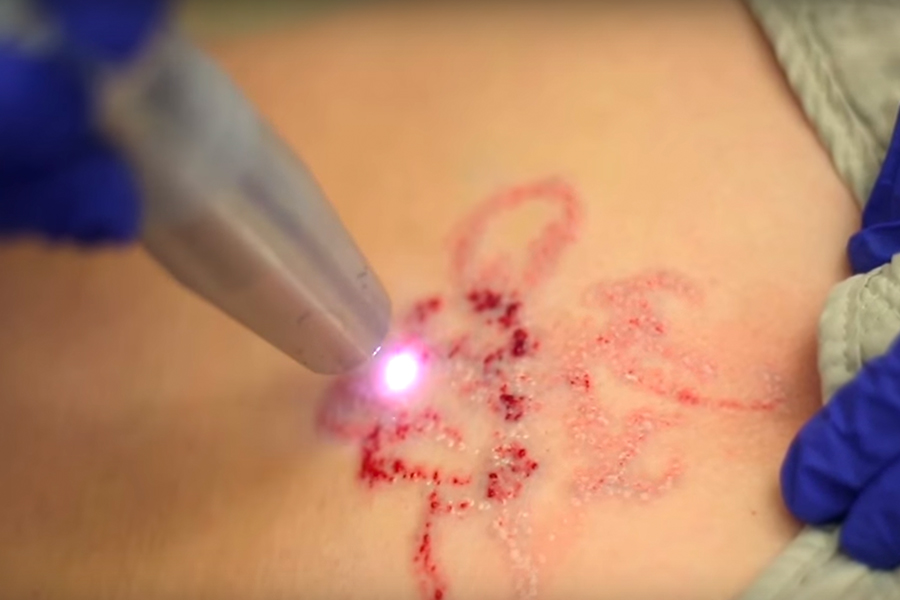 tat-removal
