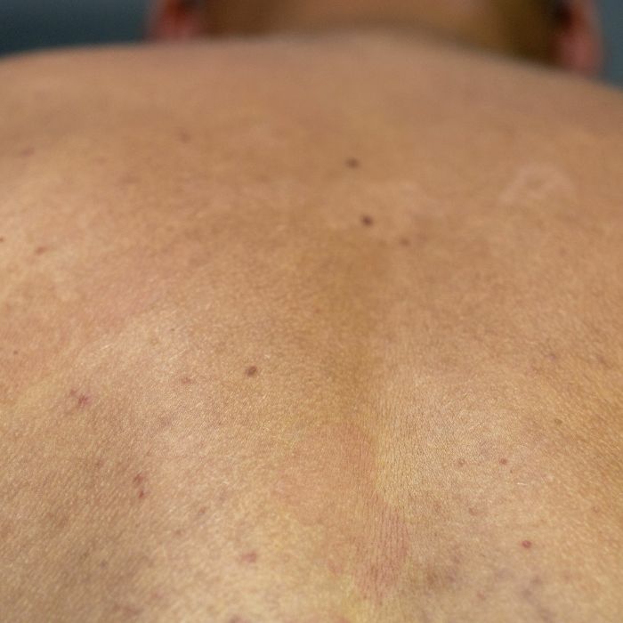 Common & Misunderstood – Tinea Versicolor